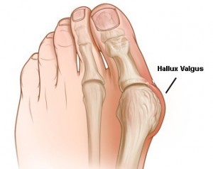 Hallux valgus al piciorului la adulți: tratament